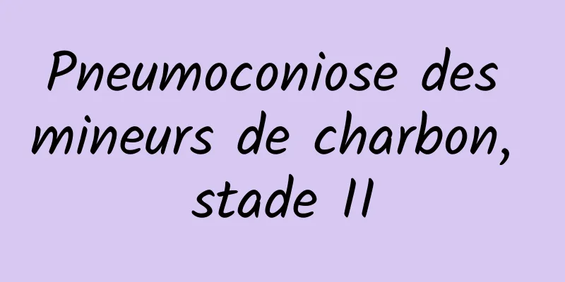 Pneumoconiose des mineurs de charbon, stade II