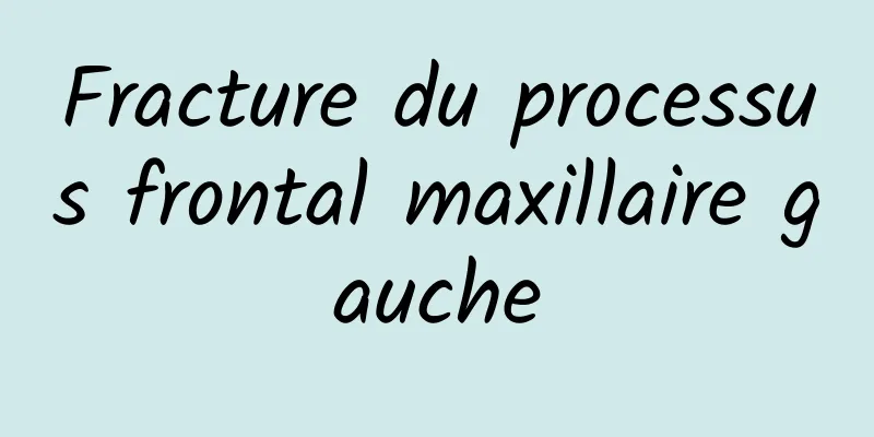 Fracture du processus frontal maxillaire gauche