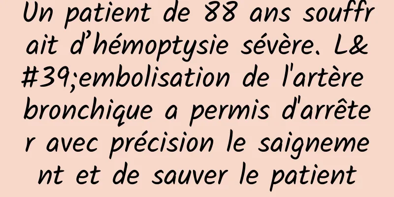 Un patient de 88 ans souffrait d’hémoptysie sévère. L'embolisation de l'artère bronchique a permis d'arrêter avec précision le saignement et de sauver le patient