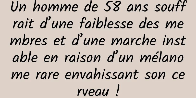 Un homme de 58 ans souffrait d’une faiblesse des membres et d’une marche instable en raison d’un mélanome rare envahissant son cerveau !