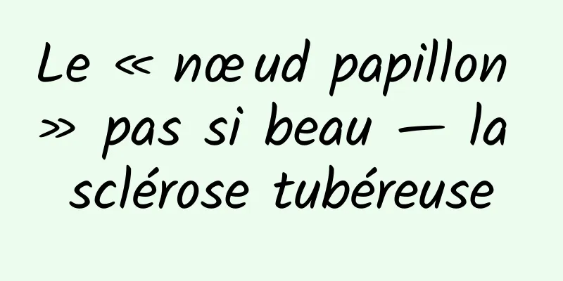 Le « nœud papillon » pas si beau — la sclérose tubéreuse