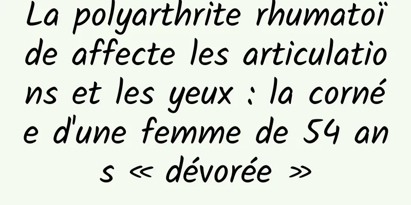 La polyarthrite rhumatoïde affecte les articulations et les yeux : la cornée d'une femme de 54 ans « dévorée »