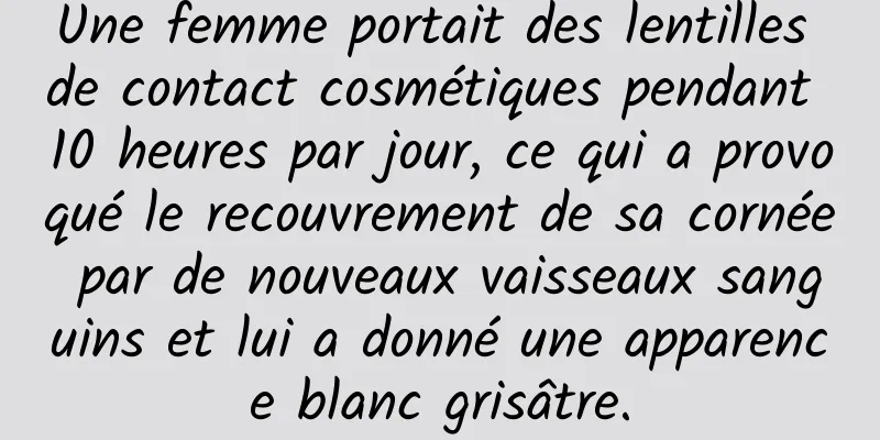 Une femme portait des lentilles de contact cosmétiques pendant 10 heures par jour, ce qui a provoqué le recouvrement de sa cornée par de nouveaux vaisseaux sanguins et lui a donné une apparence blanc grisâtre.