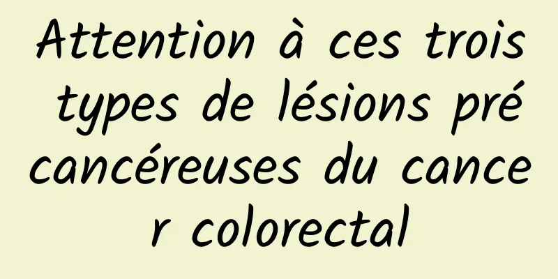 Attention à ces trois types de lésions précancéreuses du cancer colorectal