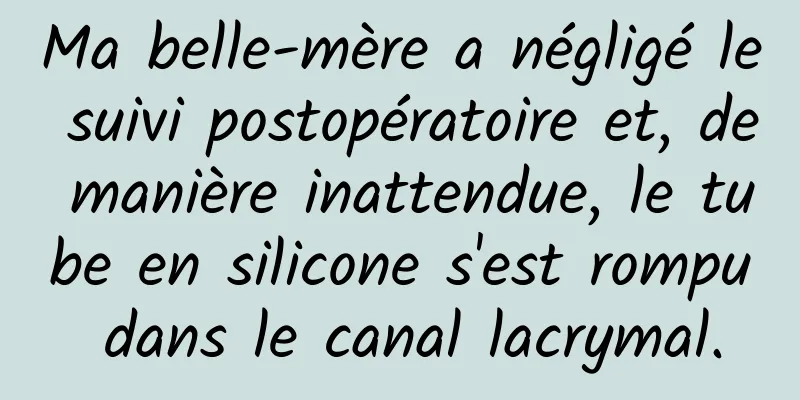 Ma belle-mère a négligé le suivi postopératoire et, de manière inattendue, le tube en silicone s'est rompu dans le canal lacrymal.