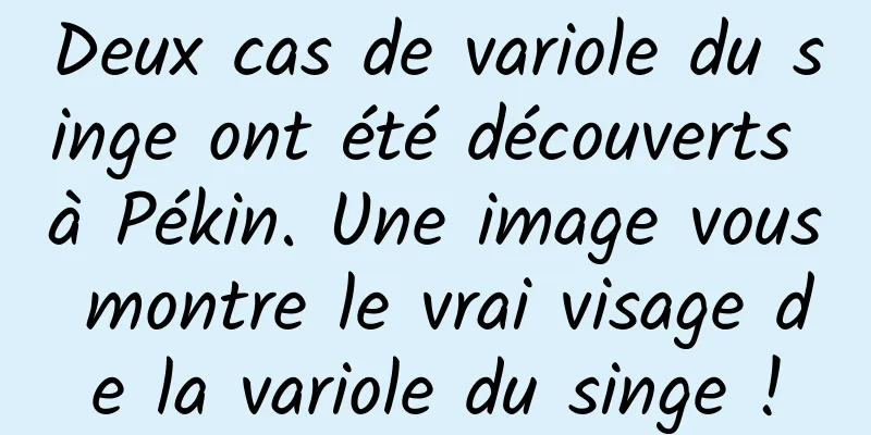 Deux cas de variole du singe ont été découverts à Pékin. Une image vous montre le vrai visage de la variole du singe !