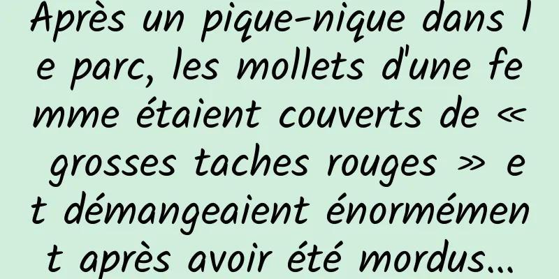 Après un pique-nique dans le parc, les mollets d'une femme étaient couverts de « grosses taches rouges » et démangeaient énormément après avoir été mordus...